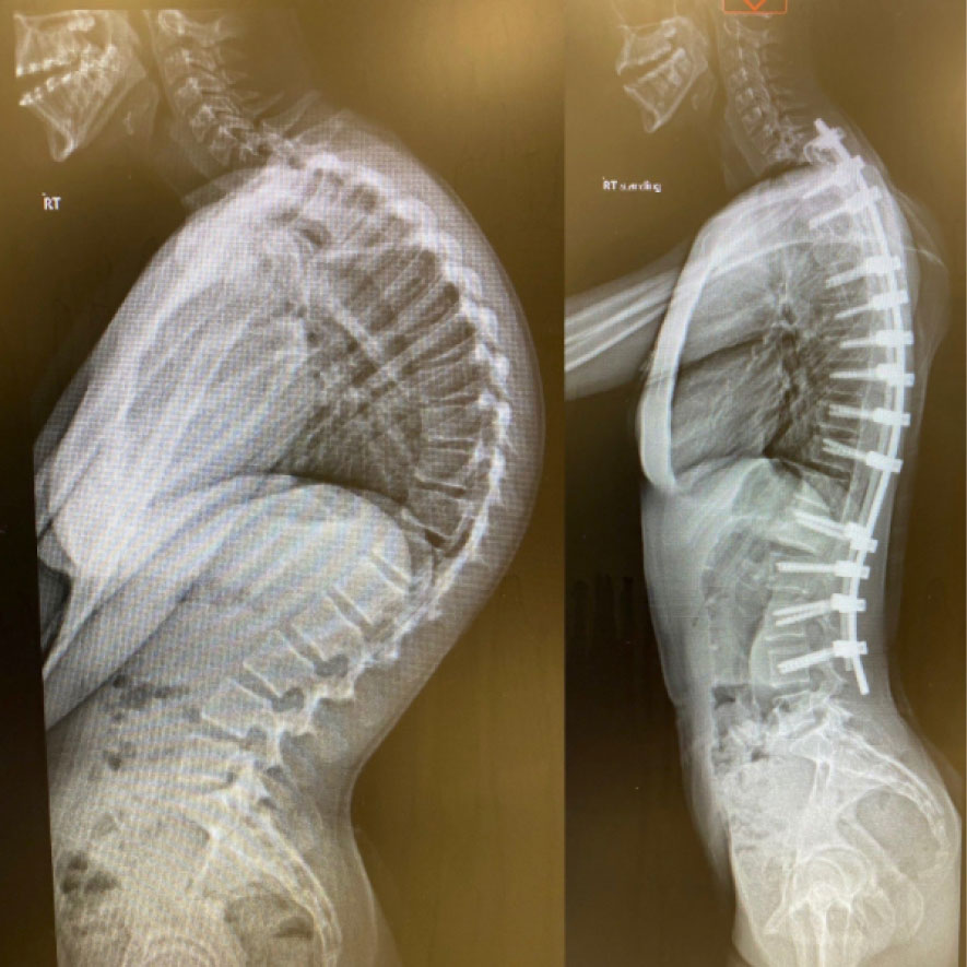 Patient thank-you card – Kyphosis Surgery